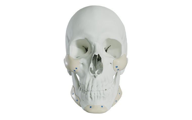 A front-facing skull with multiple midface and mandible PEEK implants fixated.