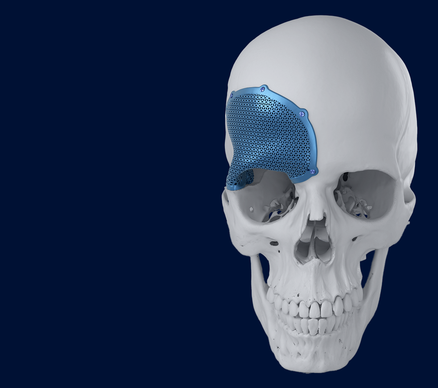 Cranial reconstruction surgery