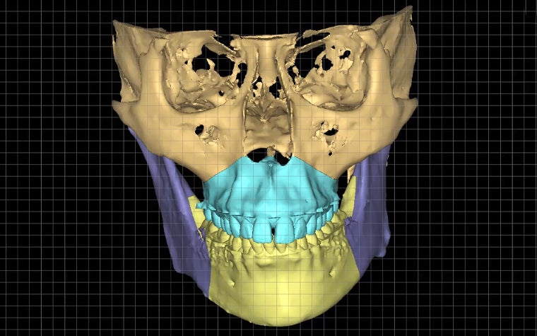 Virtual Planning for Orthognathic Surgery with Mimics Enlight CMF