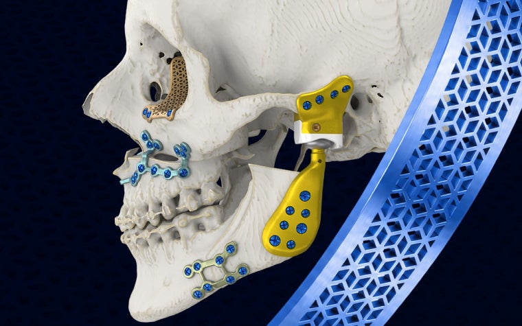 Un modelo de cráneo con varios implantes personalizados impresos en 3D alrededor de la mandíbula y la órbita.