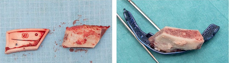 An image on the left shows the patient's iliac crest harvested during surgery next to a guide. The image on the right shows the iliac crest placed within a patient-specific reconstruction cage.