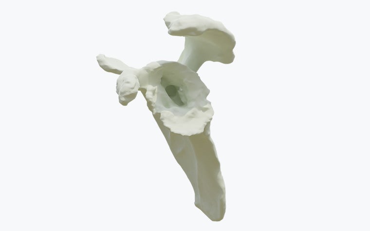 Virtual model demonstrating a central cavity in the glenoid bone