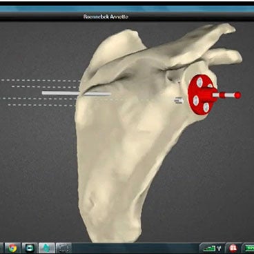The Future in Shoulder Replacement Surgery: The Integration of 3D Planning and Guides in the Clinical Workflow
