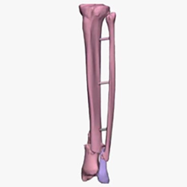How to Segment & Prepare Bones for 3D Printing in Mimics Innovation Suite