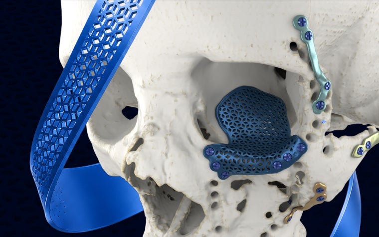 Skull model with various 3D-printed CMF implants in place