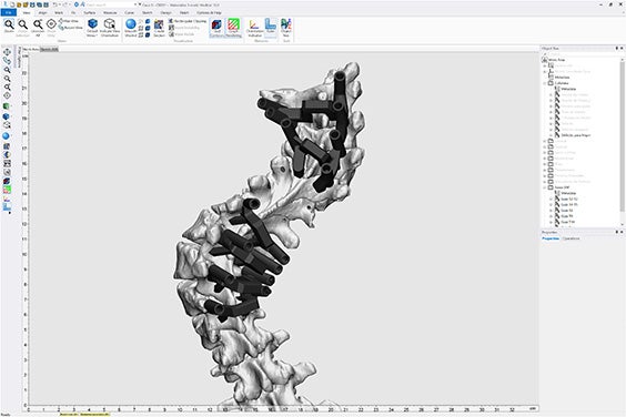 Captura de pantalla del software Materialise 3-matic con la anatomía de la columna vertebral del paciente y las guías personalizadas colocadas en los pedículos.