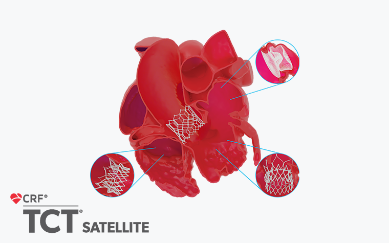 A digital illustration of a human heart with highlighted areas showing stent placements
