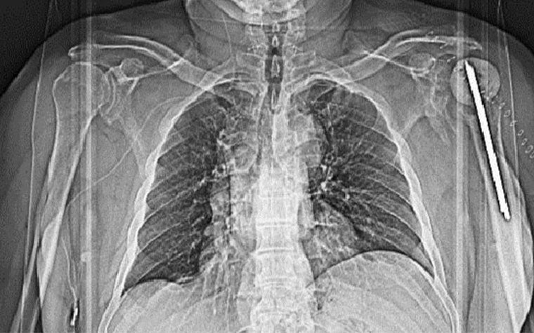 Anatomy scan of a patient's torso with a shoulder implant