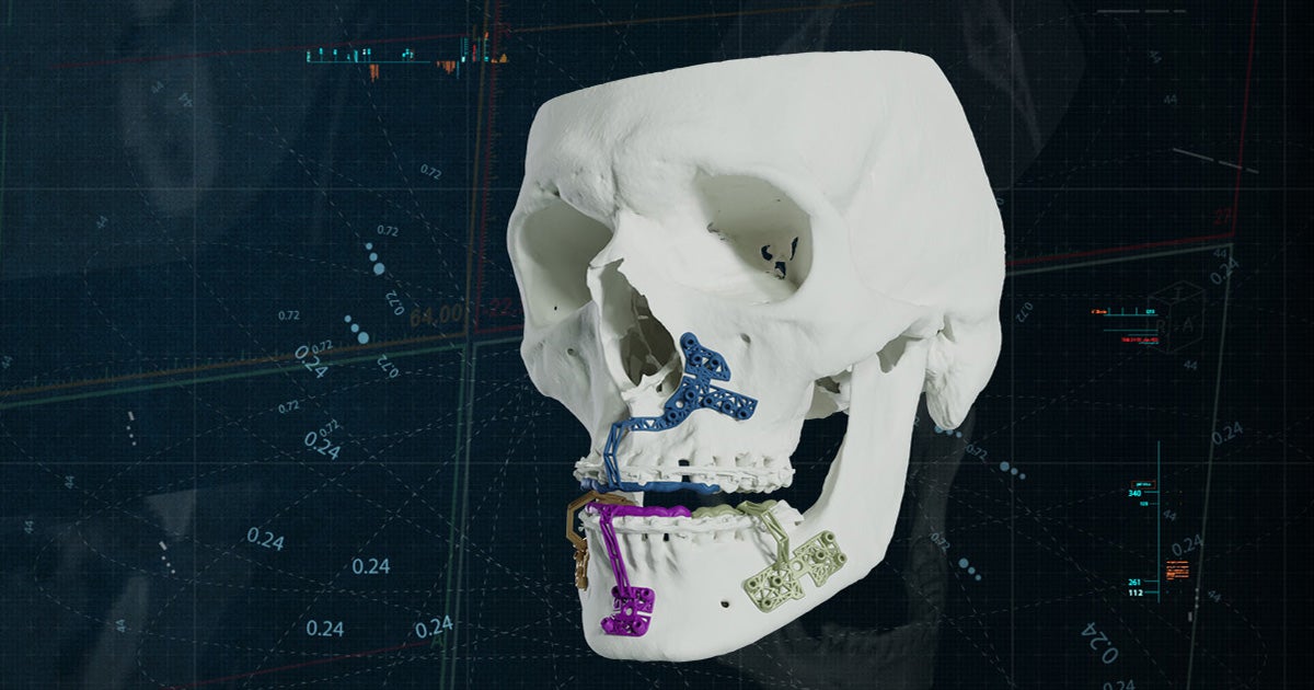 【SURGERY】bone embossing ma-1 og-materialise-cmf-solutions-