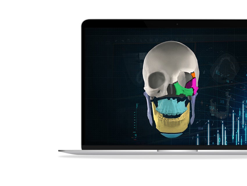 A 3D render of a human skull, segmented into multi-colored sections shown on a laptop.