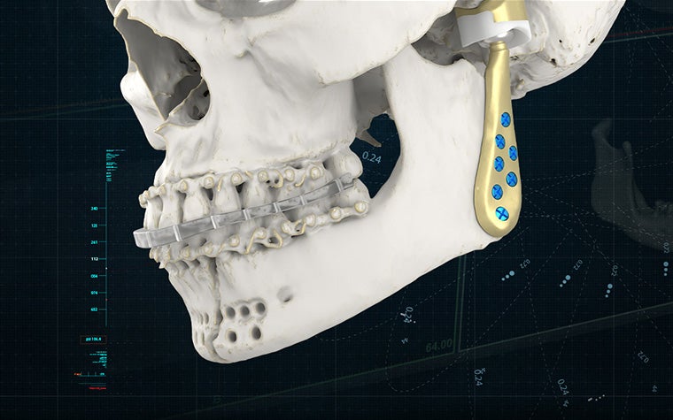 A skull model with a 3D-printed, personalized TMJ implant attached
