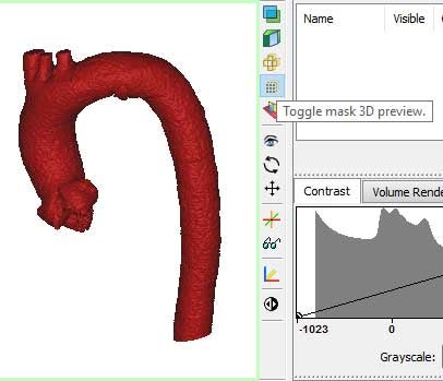 Materialise HeartPrint  3D-Printed Cardiovascular Models