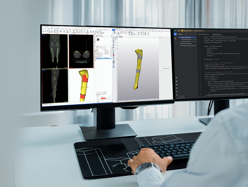 A view over the shoulder of a person working at a desk with two monitors: one showing a script in Python, and the other displaying patient scans, segmented anatomy, and a personalized surgical guide design in Materialise Mimics