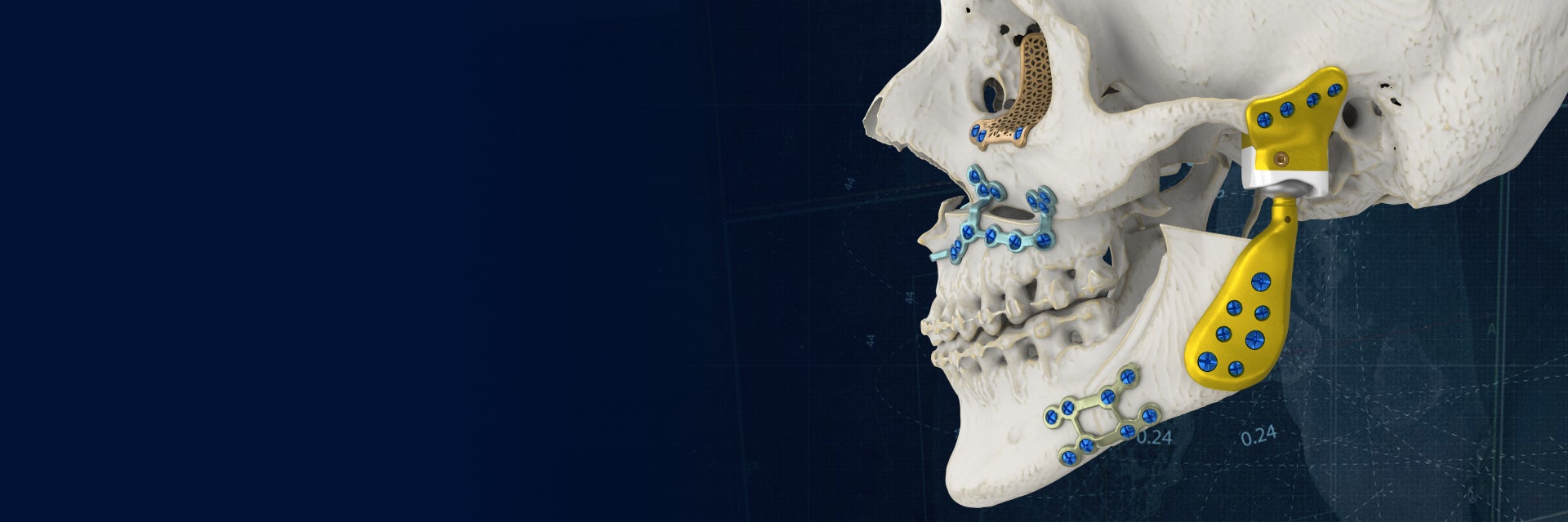 A skull model with various personalized, 3D-printed implants around the jaw and orbital socket