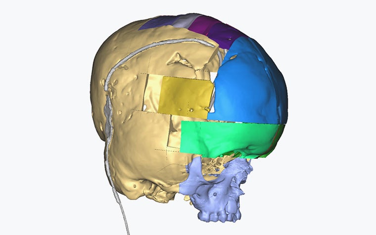Digital rendering of an infant human skull with multicolored segmented cranial implant sections in blue, green, yellow, and purple.