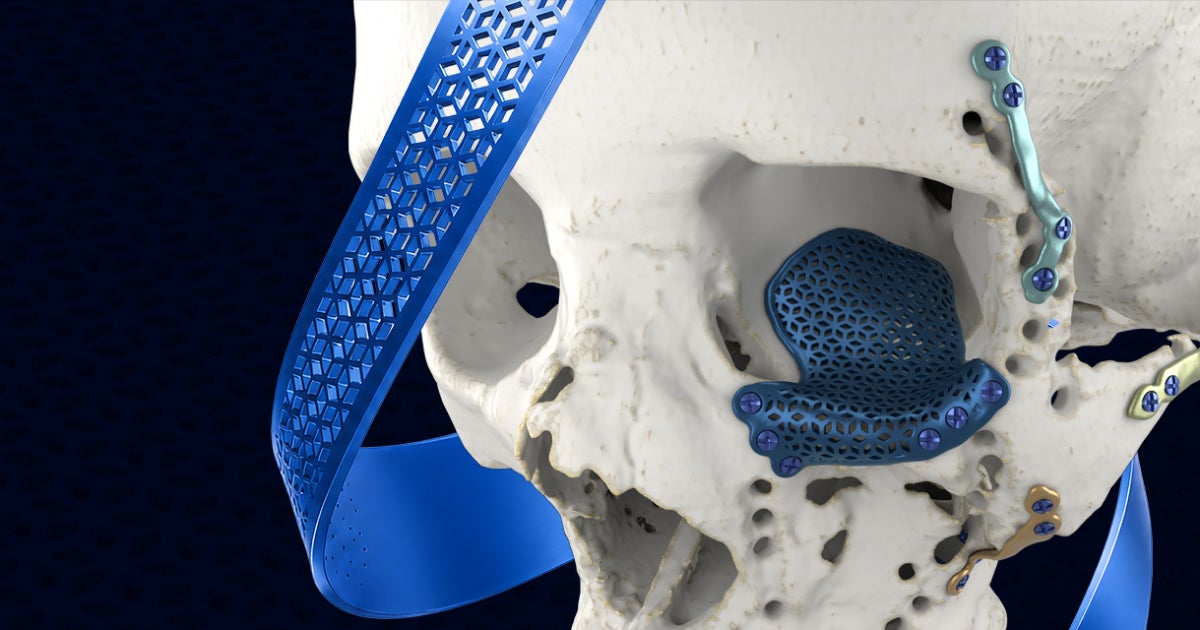 Trauma | 3D Guides and 3D Personalized Trauma Implants
