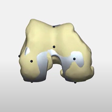 How to personalize knee alignment with 3D planning and guides