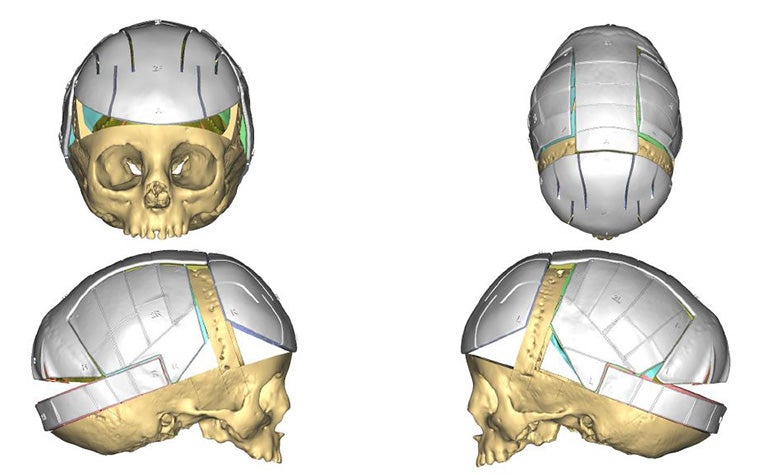 4 angels of a skull model with personalized positioning guides attached