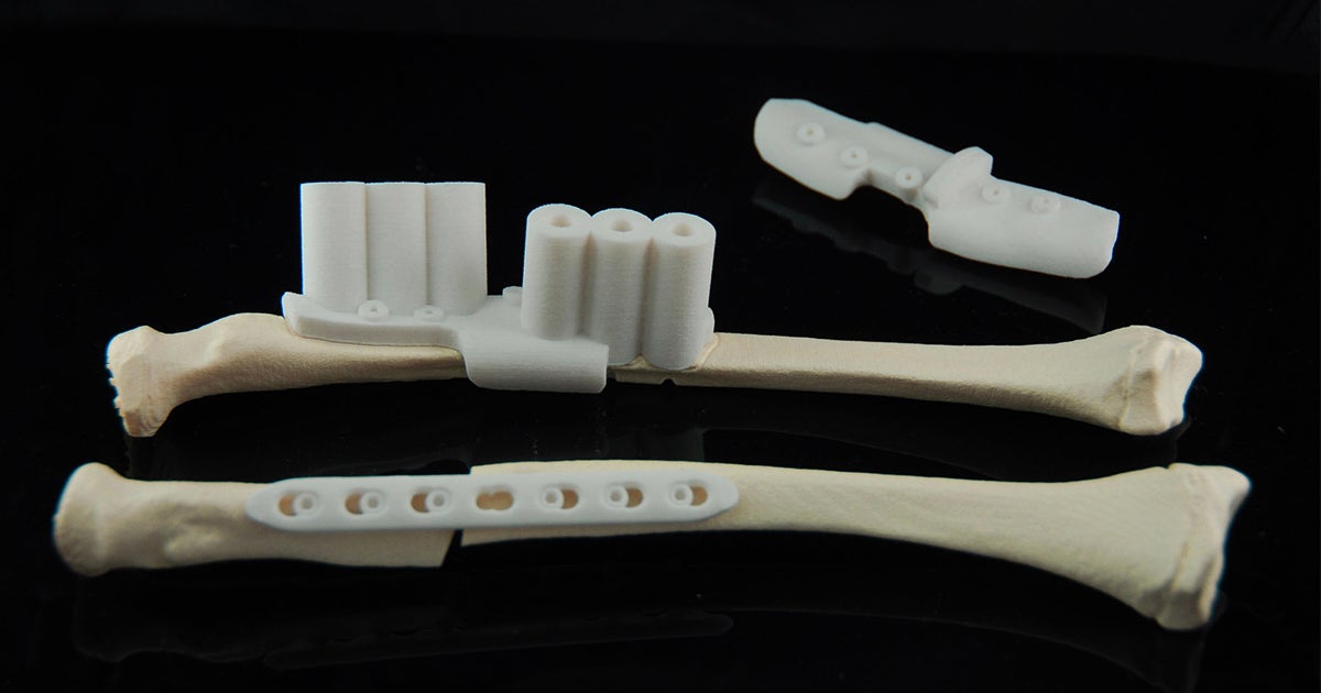 Pioneering Swedish Case Uses Materialise's Personalized Guides