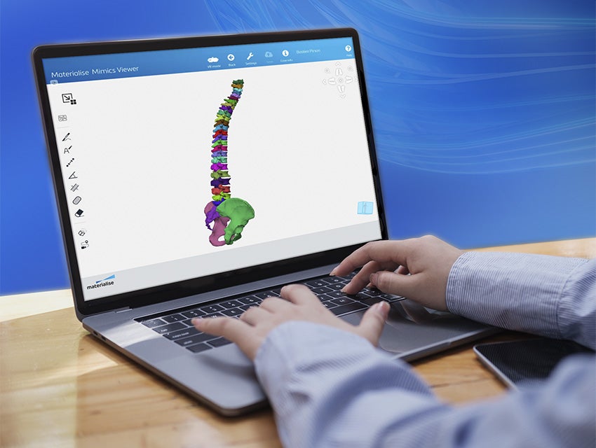 Hands using the keyboard of a laptop with the Materialise Mimics Viewer software, showing a segmented 3D model of a patient's spine and hips