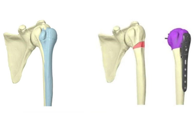 Digital images of a shoulder bone, with the surgical guide on top in the final image