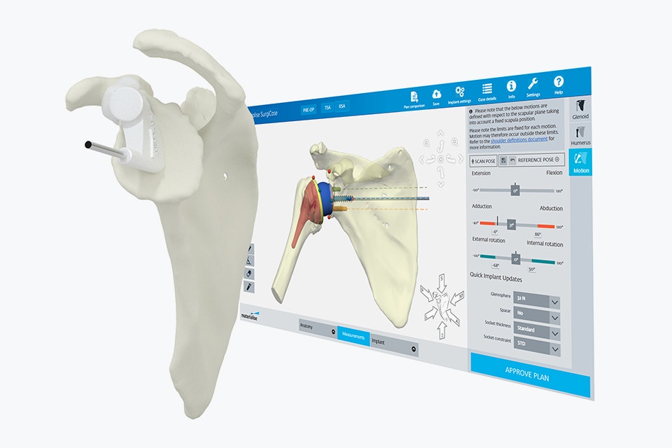 Personalized 3D Planning and Guides for Shoulder Arthroplasty