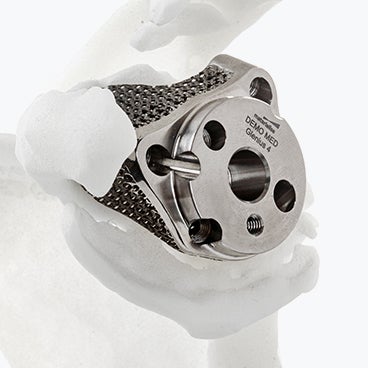 Surgical Technique: Glenius