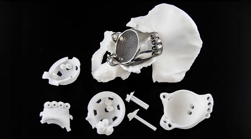 3D-printed implant in a hip model next to 3D-printed surgical guides