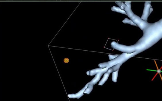 Tutorial: Create a 3D Model of an Abdominal Aortic Aneurysm