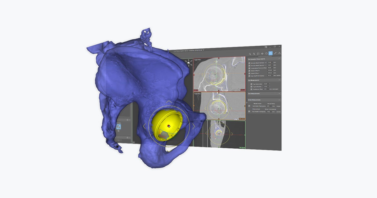 Materialise OrthoView 3D Hip | Complex Hip Arthroplasty Planning