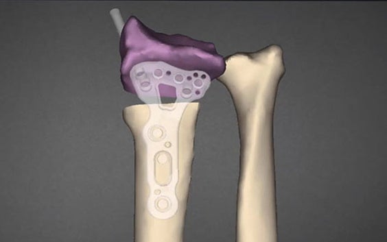 3D Osteotomy Planning with the Clinical Engineer