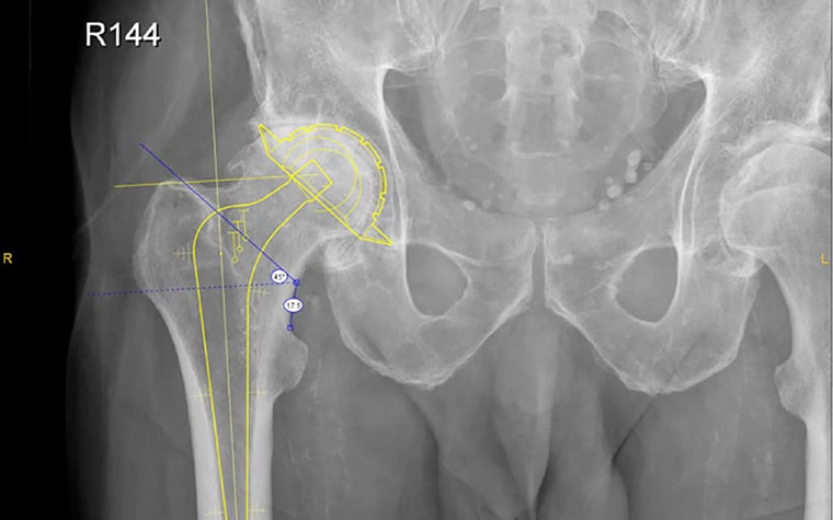 Study of Sizing Accuracy for Digitally Templating the Exeter Hip