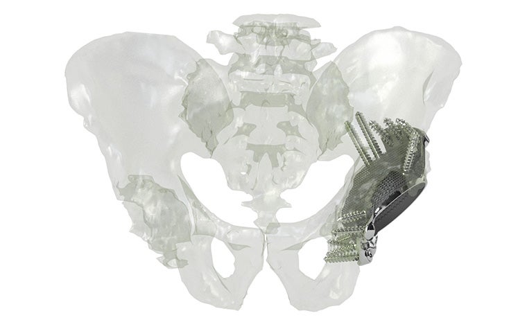 A transparent digital model a human pelvis with a fully opaque aMace hip implant screwed into one hip