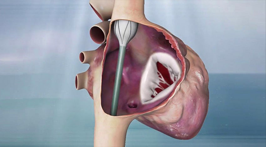 Digital image of a valve replacement