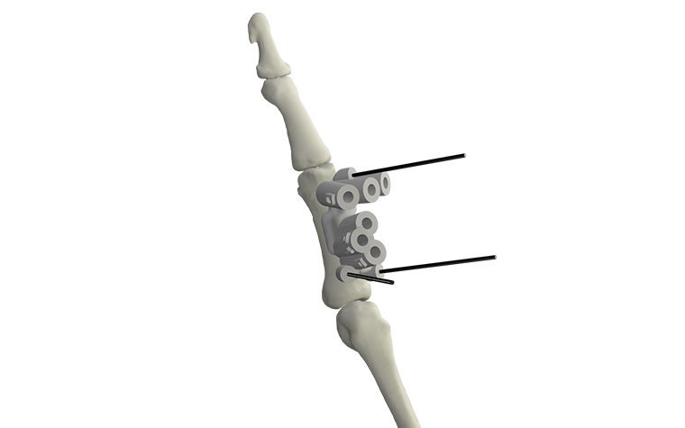 materialise-osteotomies-solutions-3d-printed-guides-indication-hand-finger-model.jpg
