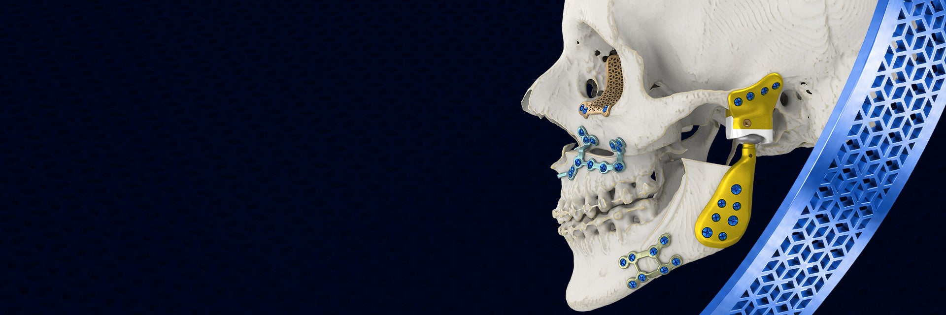 Un modelo de cráneo con varios implantes personalizados impresos en 3D alrededor de la mandíbula y la órbita.