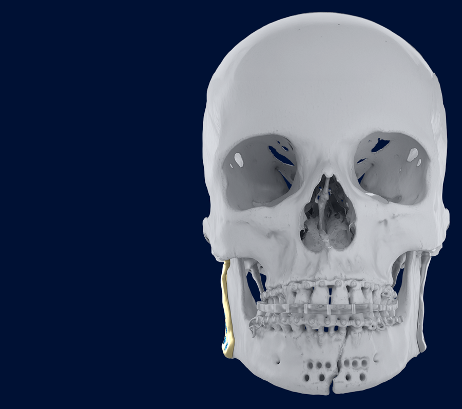 TMJ total arthroplasty