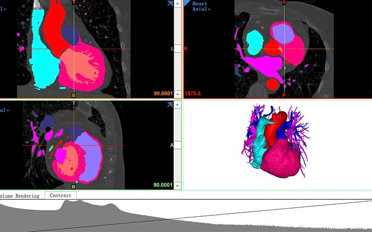 How Statistical Shape Modeling Supports Structural Heart Device Design ...