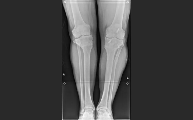Pre-op AP X-ray showing the patient's significant knee joint obliquity