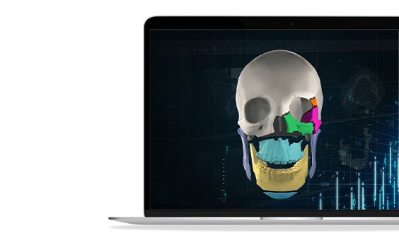 A 3D render of a human skull, segmented into multi-colored sections shown on a laptop.