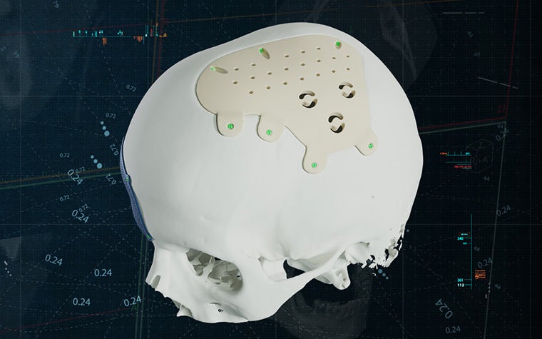 A white skull with a Materialise CMF PEEK implant on a blue background.