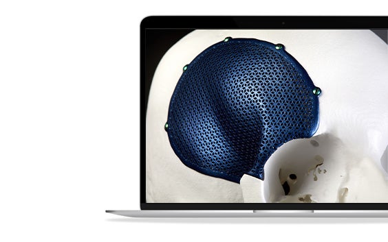 A 3D-printed, porous, titanium CMF implant shown on a skull.