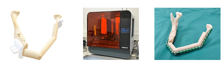 Sequence showing a 3D-printed jawbone model, a 3D printer with an orange protective cover, and a jawbone model fitted with a metal surgical plate on a green sterile cloth.
