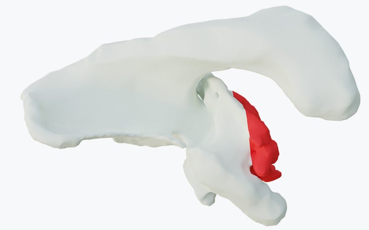 Virtual model of a shoulder bone with excessive version