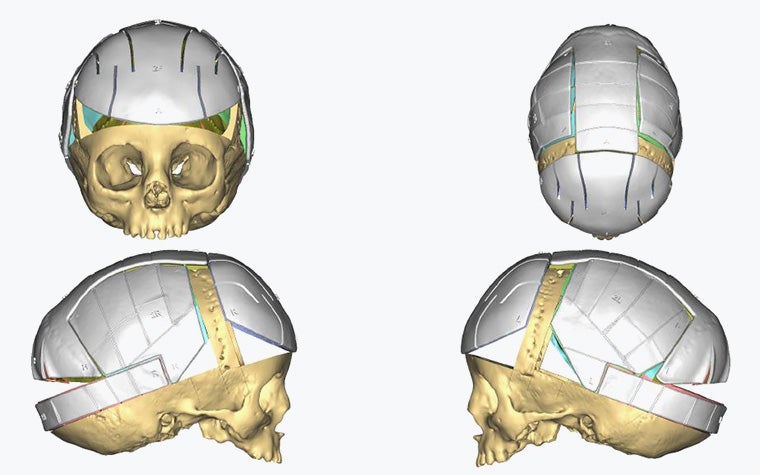 Four angles of an infant skull model with personalized positioning guides attached.