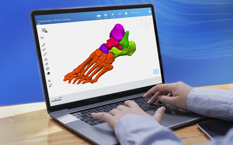 Die Hände benutzen die Tastatur eines Laptops mit der Materialise Mimics Viewer Software und zeigen ein segmentiertes 3D-Modell des Knöchels eines Patienten.