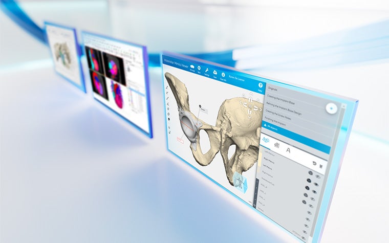 Trois écrans montrant l'anatomie du patient dans le logiciel de la plateforme Materialise Mimics sur un fond blanc réfléchissant avec des lignes bleues.