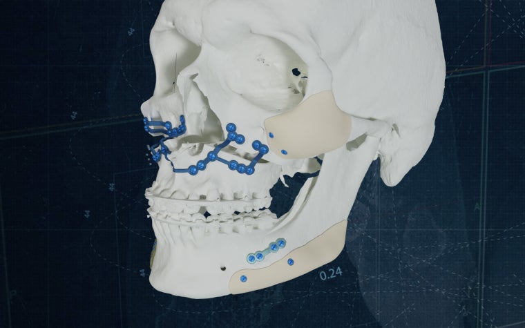 Modèle de crâne avec des plaques de titane imprimées en 3D sur fond bleu.