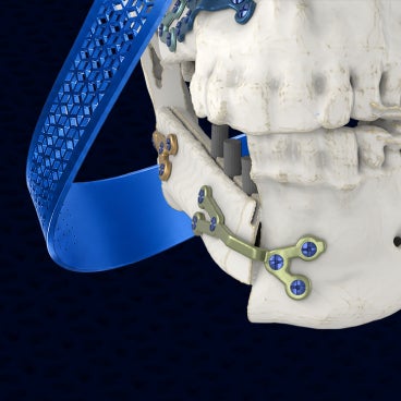 Reconstructive Surgery | Cranio-Maxillofacial Solutions | Materialise