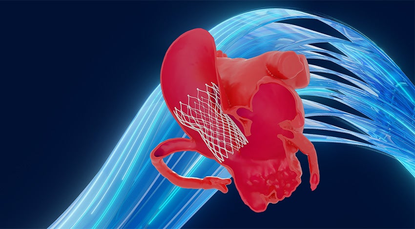 TAVR shown in a cutaway anatomy of a heart with a blue Mimics swirl background.